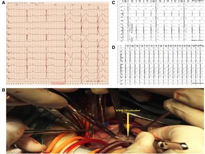 Case report: Recovery of long-term delayed complete atrioventricular block after minimally invasive transthoracic closure of ventricular septal defect